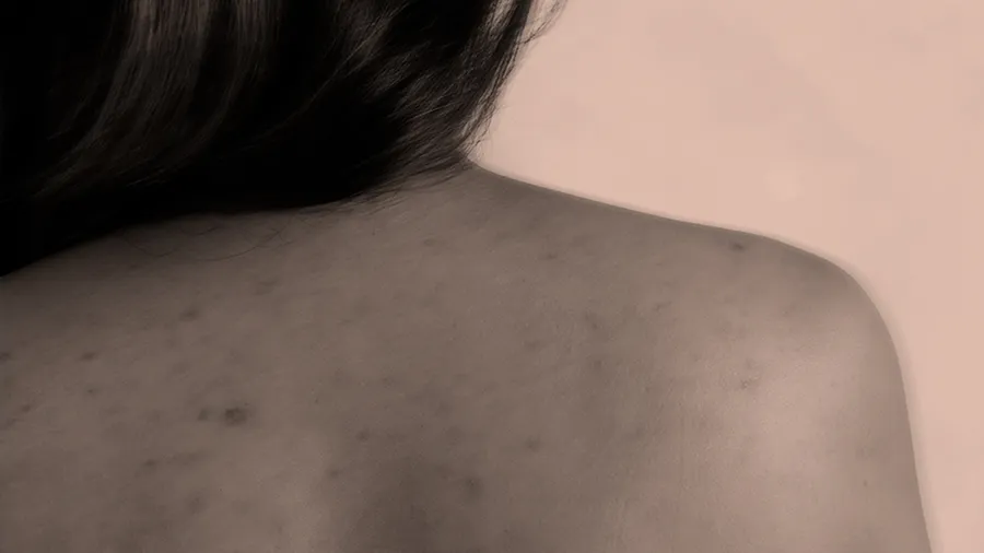 ¿Qué es el bacné? Te decimos cómo prevenirlo y tratarlo.