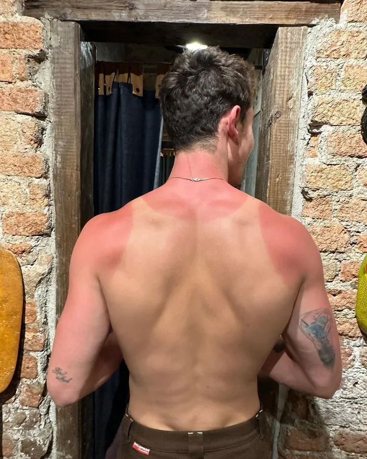 Shawn Mendes olvidó aplicarse bloqueador mientras visitaba las pirámides de Teotihuacán. 