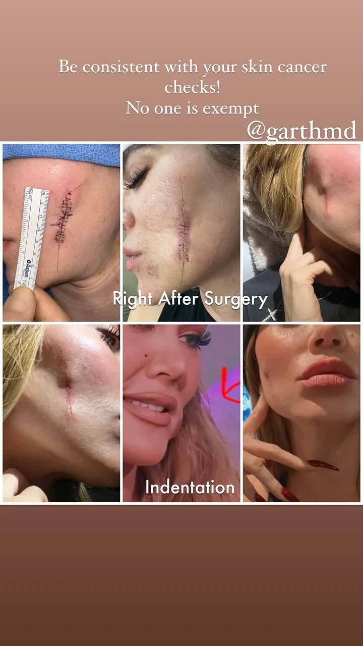 Khloé Kardashian comparte su experiencia con el cáncer de piel.