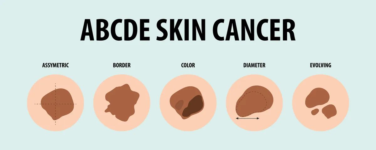 ABCDE-Melanoma