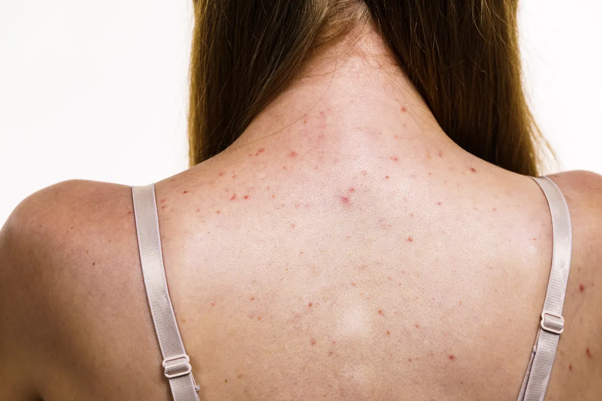 Health,Problem,,Skin,Diseases.,Young,Woman,Showing,Her,Back,With