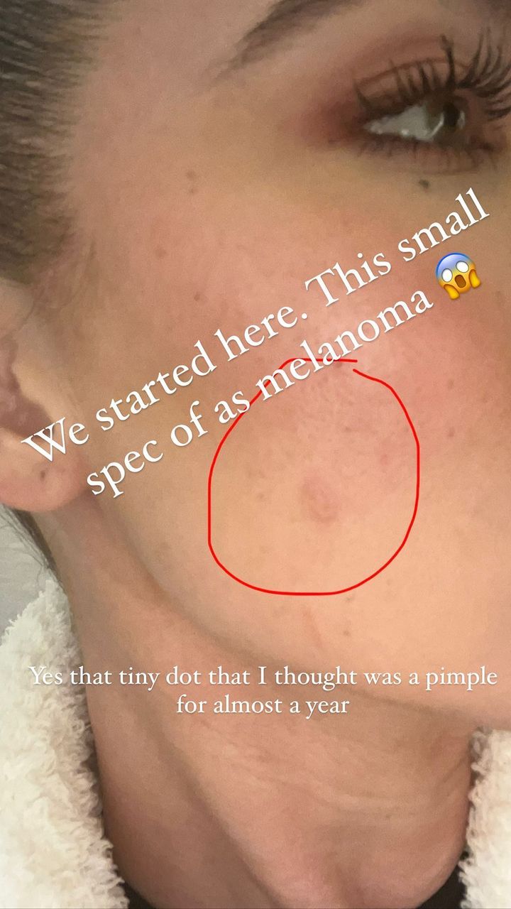 Khloé Kardashian comparte su experiencia con el cáncer de piel.