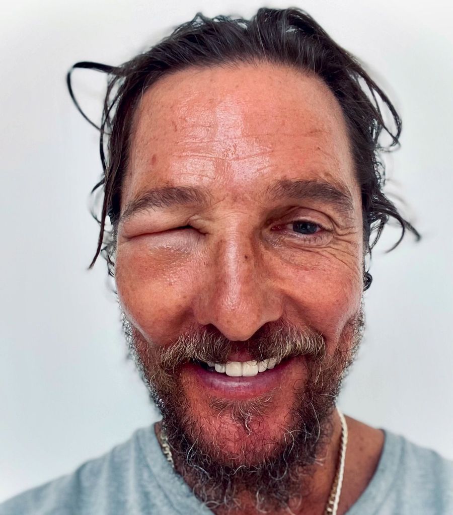 Matthew McConaughey muestra su ojo hinchado tras ser picado por una abeja