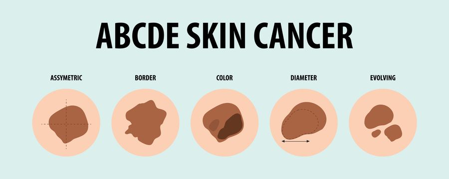 ABCDE-Melanoma