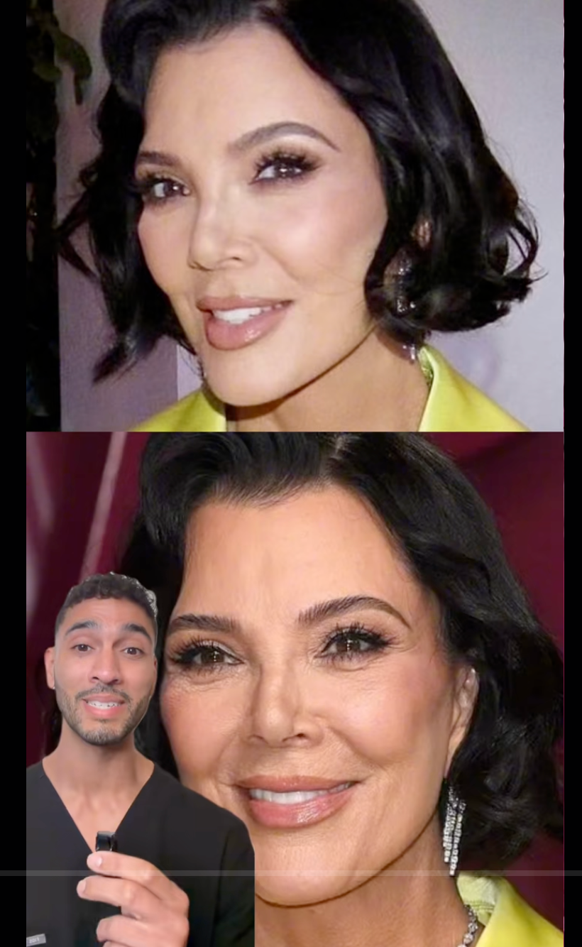 lifting-kris-jenner-antes-despues.png